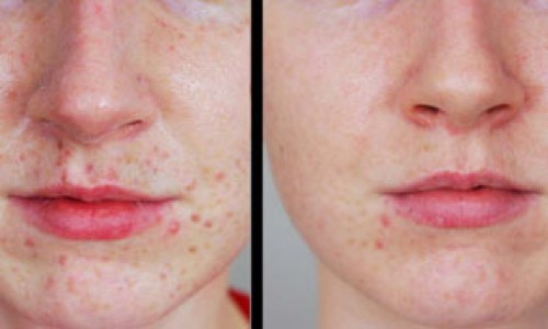 Moles, Lentiges & Freckles
