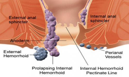 Hemorrhoids (Piles) treatment