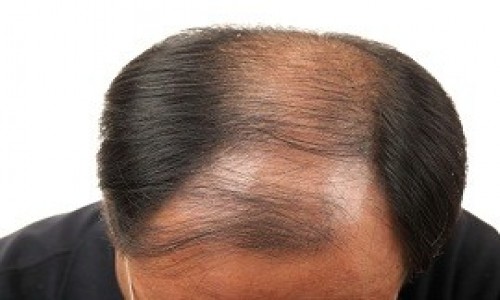 Hair Loss treatment