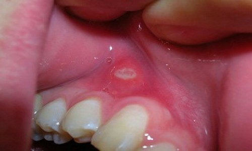 Mouth Sores treatment