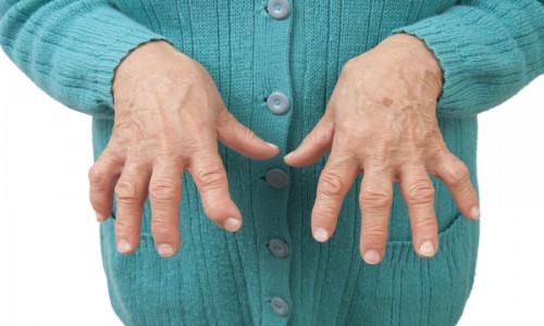 Rheumatoid Arthritis