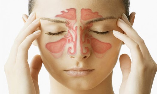 Sinusitis