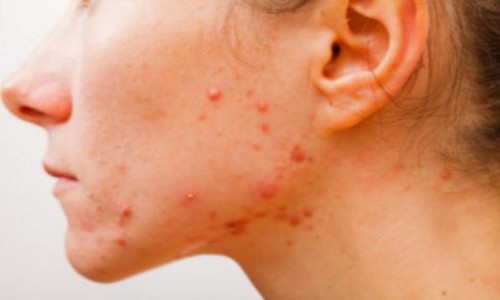 Acne pimples