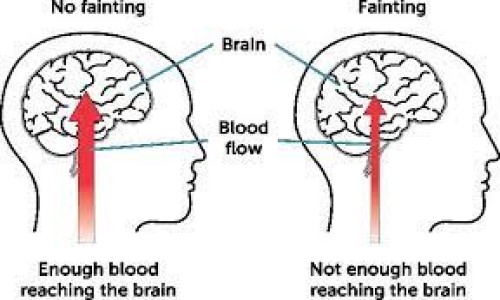 epilepsyb frequent fainting  (मिर्गी बार बार बेहोशी)