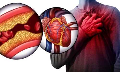 Heart disease ( हृदय रोग )