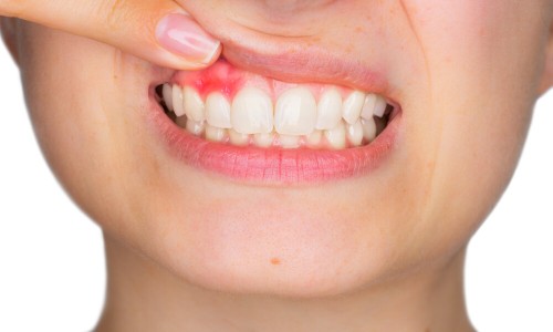 Dental abscess (दाँत का फोड़ा)