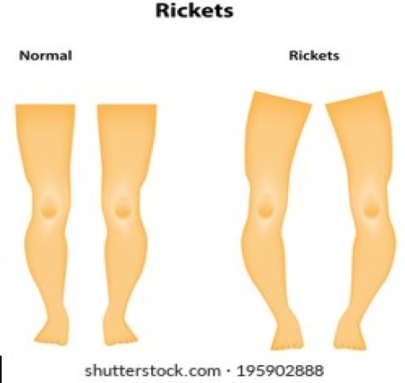 सुख रोग या रिकेट्स