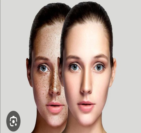 काले धब्बे... (Dark Spot) हटाने के लिए  घरेलू नुस्खा।