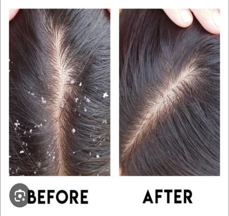 अगर आप भी है डेंड्रफ से परेशान तो ये नुस्खा जरूर ट्राय करें।