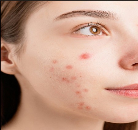 अगर आप भी अपने सुंदर चेहरे पर निकल रहे पिंपल्स से परेशान है तो ये घरेलू नुस्खे जरूर ट्राय करें।