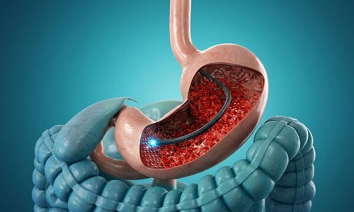 GI Endoscopy
