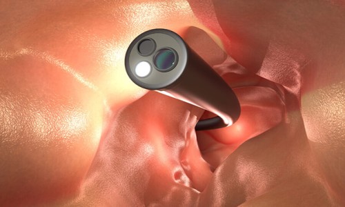 Colonoscopy