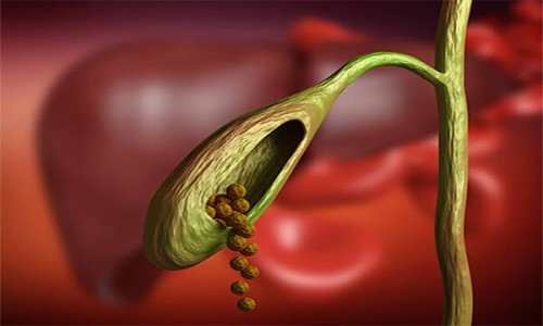 Bile Duct Stones