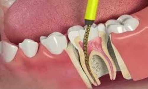 Root Cenal Treatment (RCT)