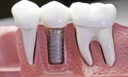 Implant Teeth