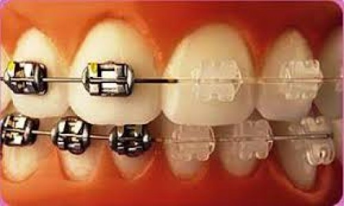 orthodontic treatment