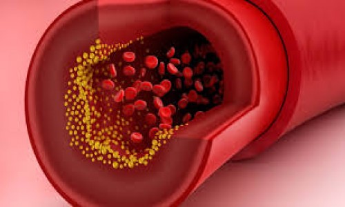 Cholesterol disorder कोलेस्ट्रॉल विकार