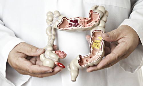 ULCERATIVE COLITIS