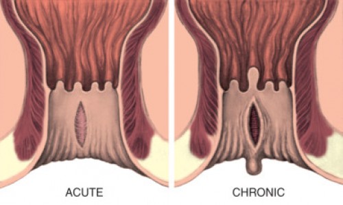 FISSURE IN ANO