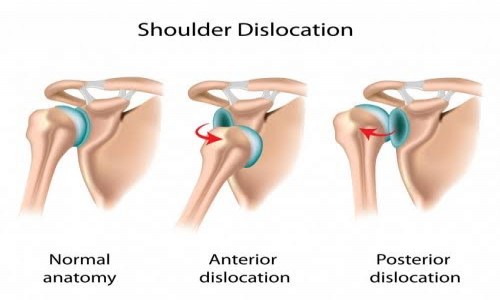 Shoulder disorders