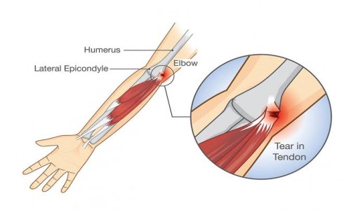 TENNIS ELBOW