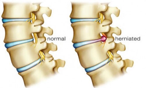 SLIP DISC/DISC PROLAPSE/SCIATICA