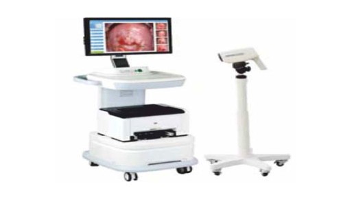 Digital Video Colposcope
